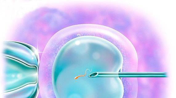 泰国试管婴儿胚胎移植疼吗